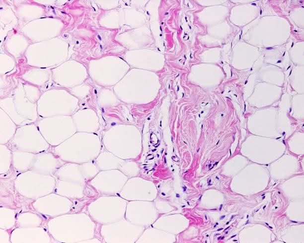 Más allá de la báscula: la grasa como un órgano inflamatorio