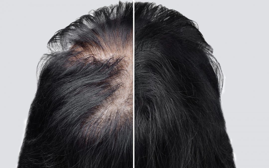 Alopecia femenina
