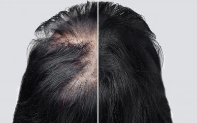 Alopecia femenina
